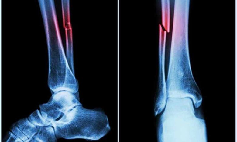 nit-की-रिसर्च:-हड्डियों-की-मरम्मत-के-लिए-प्रोटीन-से-नए-उपचार-के-रास्ते