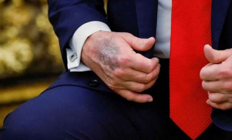 ट्रंप-के-हाथ-पर-नीले-निशान-क्यों?-‘बीमारी’-की-अटकलों-पर-राष्ट्रपति-ने-खुद-तोड़ी-चुप्पी