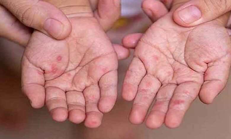 mp-में-खसरे-की-एंट्री:-4-जिलों-में-12-नए-मरीज,-स्वास्थ्य-विभाग-अलर्ट-मोड-पर;-घर-घर-सर्वे-शुरू