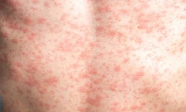 रतलाम-में-खसरे-का-प्रकोप:-10-बच्चों-में-संक्रमण,-स्वास्थ्य-विभाग-ने-किया-फ्लैग-मार्च