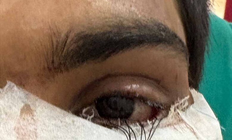 स्किन-ग्राफ्टिंग-से-मरीज-के-पलक-का-सफल-पुनर्निर्माण